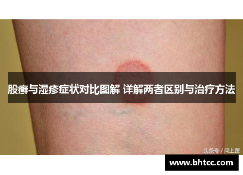股癣与湿疹症状对比图解 详解两者区别与治疗方法